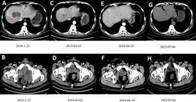 Case report: Complete response of a bladder cancer patient with multiple hepatic and pelvic metastases treated by nab-paclitaxel combined with sintilimab